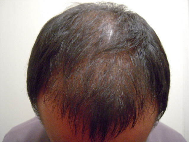 Week 2 - Front Scalp