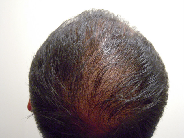 Week 3 - Back Scalp