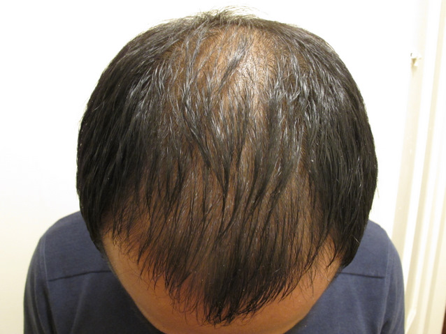 Week 1 - Front of Scalp