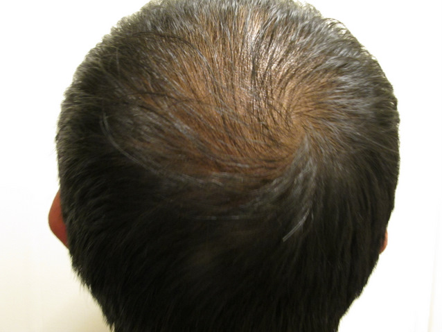 Week 1 - Back of Scalp